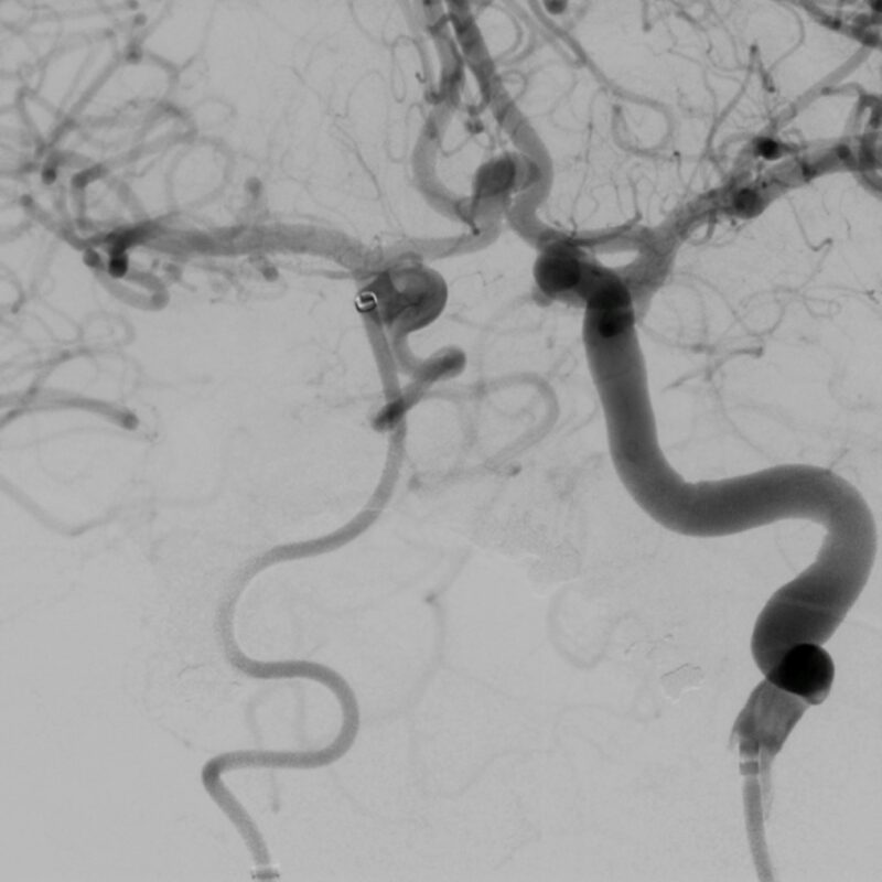 Figura 2. Imagem de arteriografia cerebral evidenciando a presena de um aneurisma sacular em topografia da artria cerebral anterior