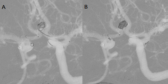 Imagem de tratamento endovascular de aneurisma sacular 