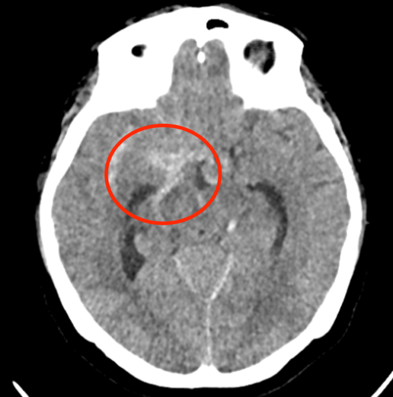 Imagem tomografia de crnio sem contraste evidenciando ruptura de um aneurisma cerebral